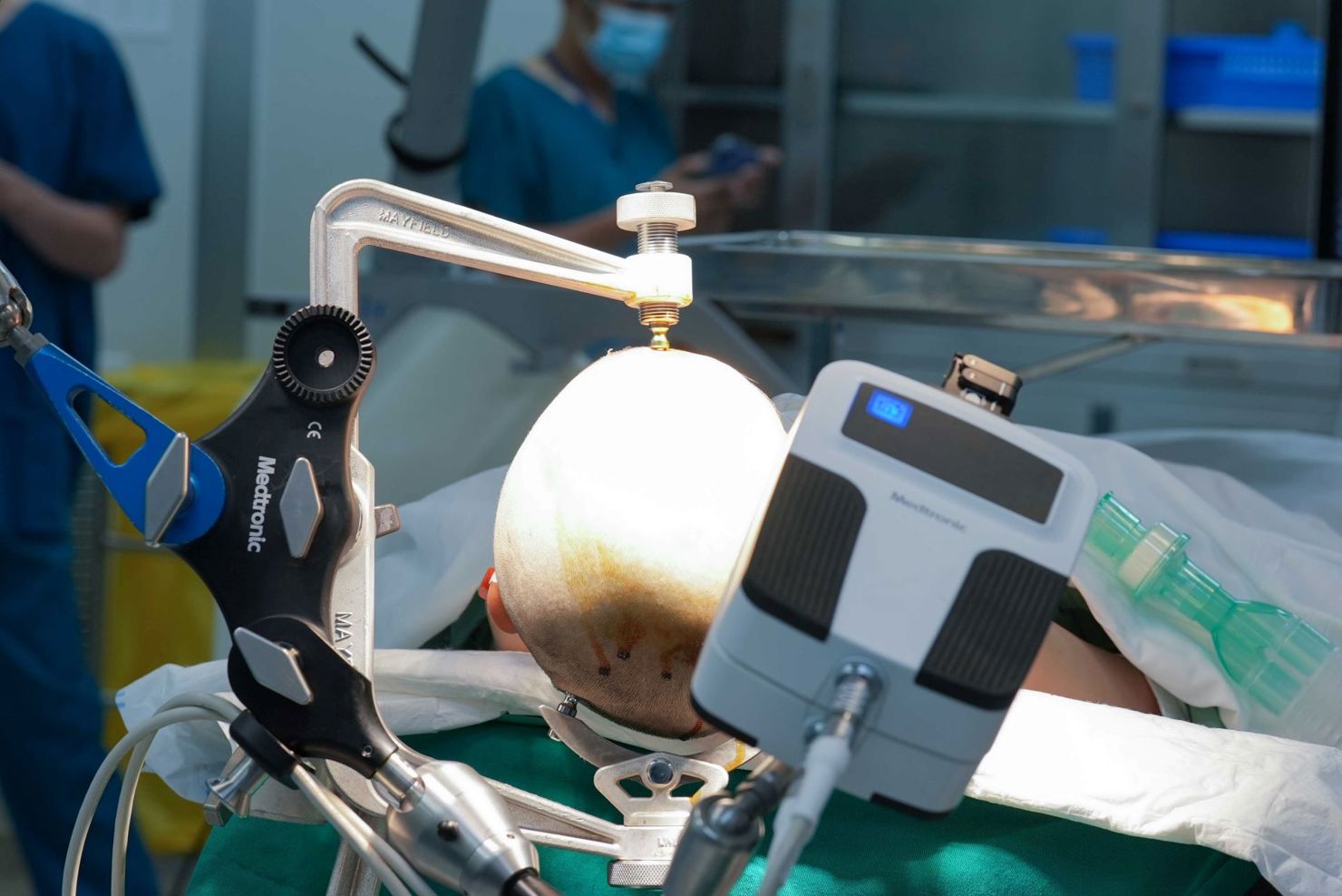 Vinmec tiên phong điều trị động kinh bằng Robot định vị thần kinh hàng đầu thế giới - Ảnh 1